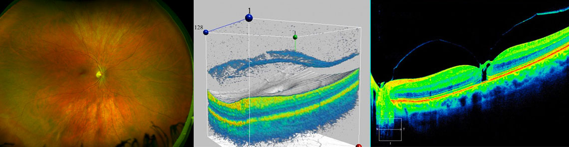 Optos Retinal Photography and OCT Sample Images